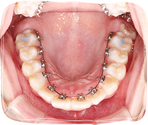 見えない矯正治療（裏側矯正）