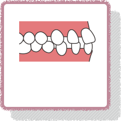 歯と歯の間にすき間がある